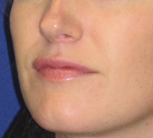 Lip Augmentation Before & After Gallery - Patient 4890910 - Image 5