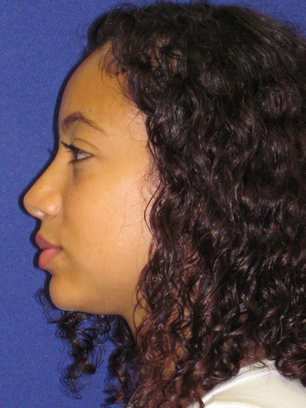 Rhinoplasty Before & After Gallery - Patient 4890911 - Image 6