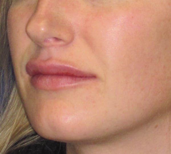 Lip Augmentation Before & After Gallery - Patient 4890910 - Image 6