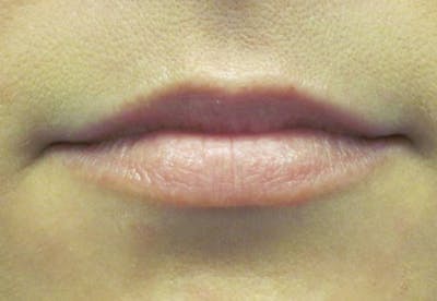 Lip Augmentation Before & After Gallery - Patient 4890913 - Image 1