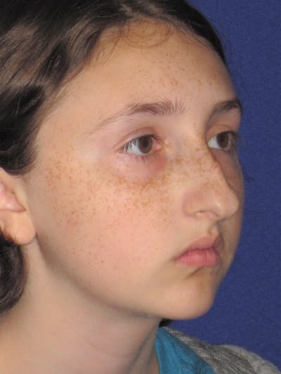 Rhinoplasty Before & After Gallery - Patient 4890914 - Image 1