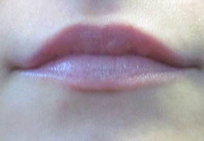 Lip Augmentation Before & After Gallery - Patient 4890913 - Image 2