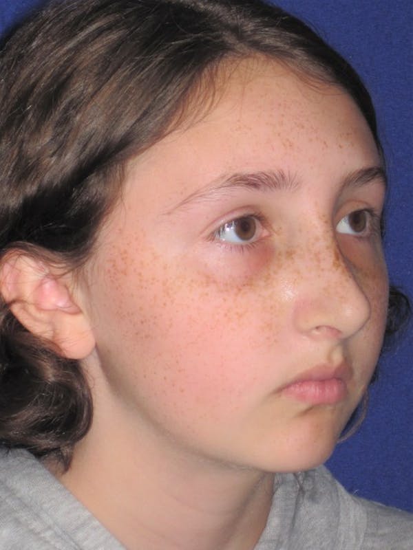 Rhinoplasty Before & After Gallery - Patient 4890914 - Image 2