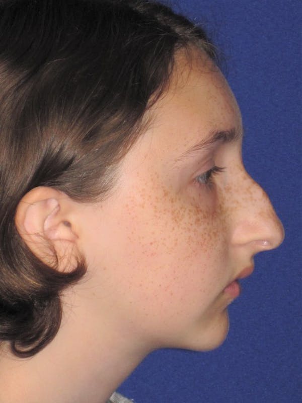 Rhinoplasty Before & After Gallery - Patient 4890914 - Image 5