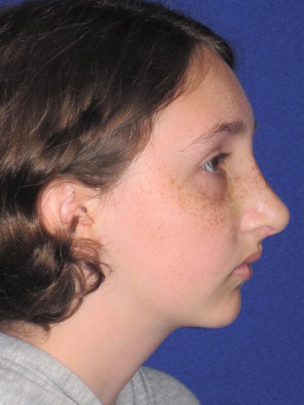 Rhinoplasty Before & After Gallery - Patient 4890914 - Image 6