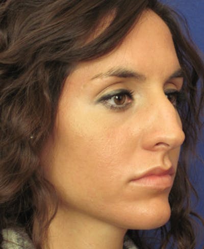 Rhinoplasty Before & After Gallery - Patient 4890916 - Image 1