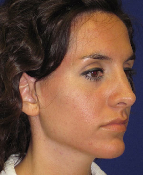 Rhinoplasty Before & After Gallery - Patient 4890916 - Image 2
