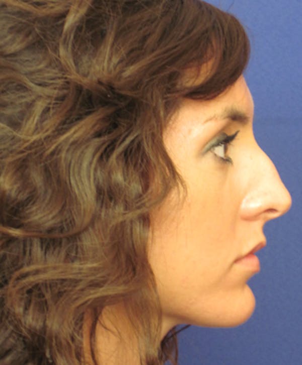 Rhinoplasty Before & After Gallery - Patient 4890916 - Image 3