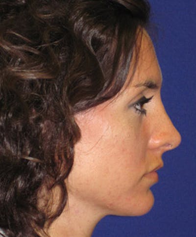 Rhinoplasty Before & After Gallery - Patient 4890916 - Image 4
