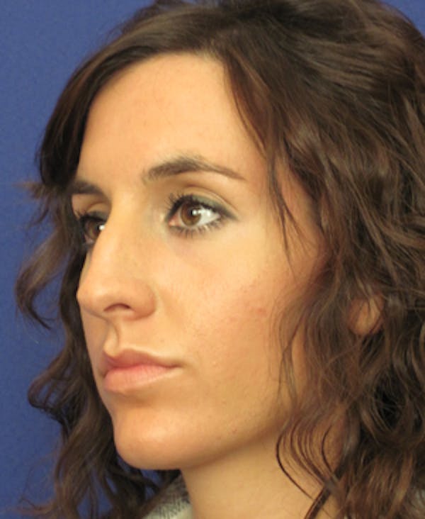 Rhinoplasty Before & After Gallery - Patient 4890916 - Image 5