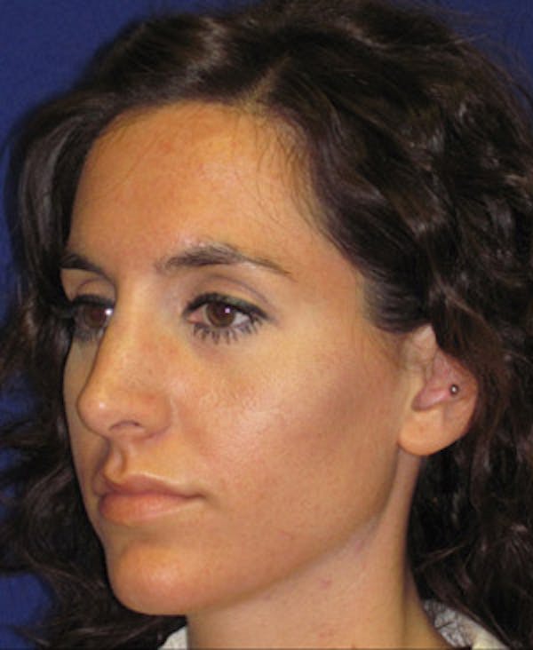Rhinoplasty Before & After Gallery - Patient 4890916 - Image 6