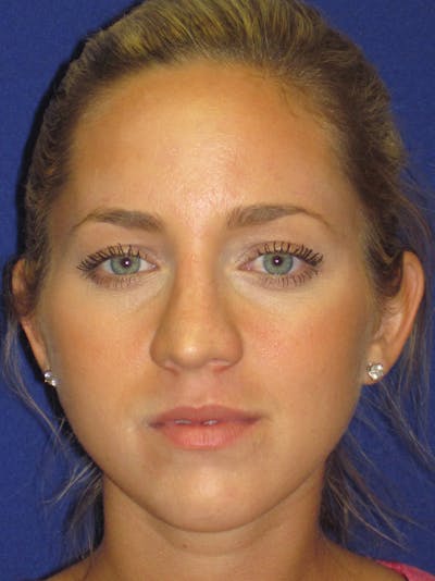 Rhinoplasty Before & After Gallery - Patient 4890919 - Image 1