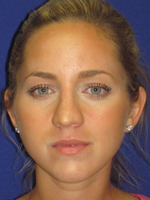 Rhinoplasty Before & After Gallery - Patient 4890919 - Image 1