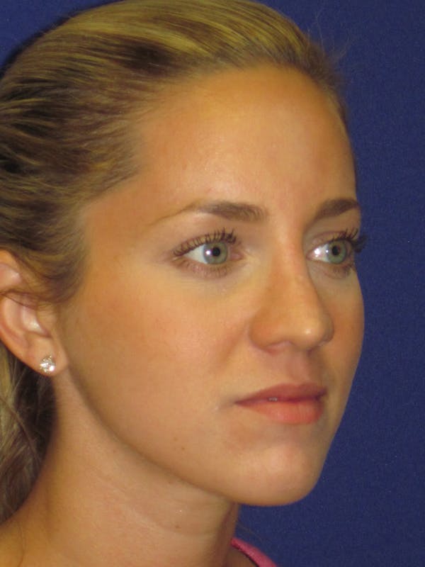 Rhinoplasty Before & After Gallery - Patient 4890919 - Image 3