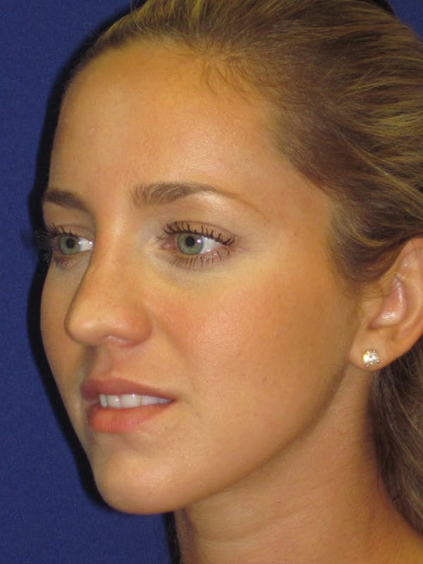 Rhinoplasty Before & After Gallery - Patient 4890919 - Image 5