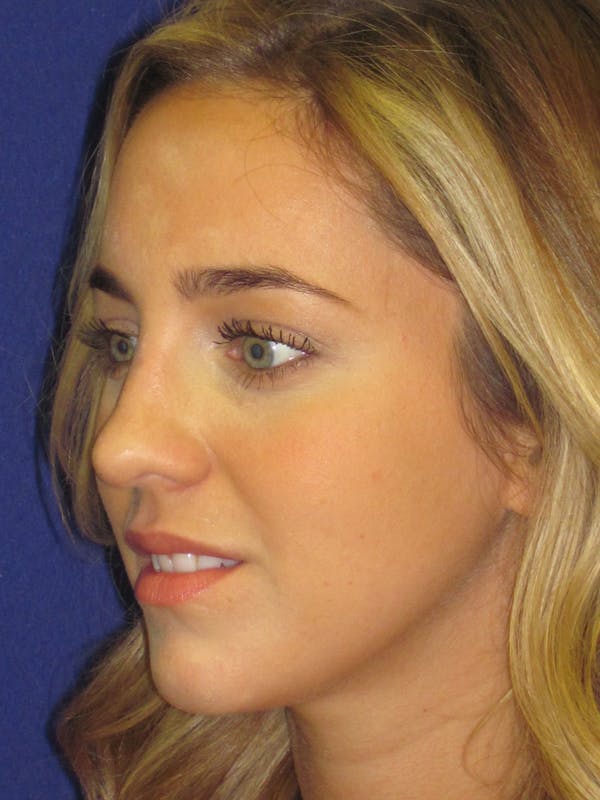 Rhinoplasty Before & After Gallery - Patient 4890919 - Image 6