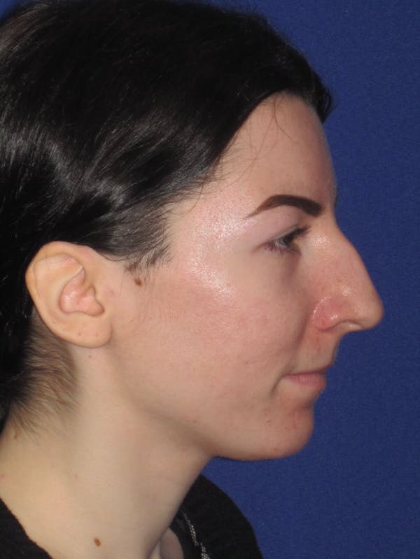Rhinoplasty Before & After Gallery - Patient 4890973 - Image 1