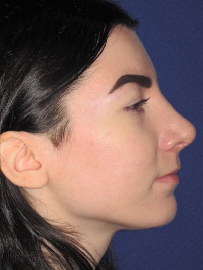 Rhinoplasty Before & After Gallery - Patient 4890973 - Image 2