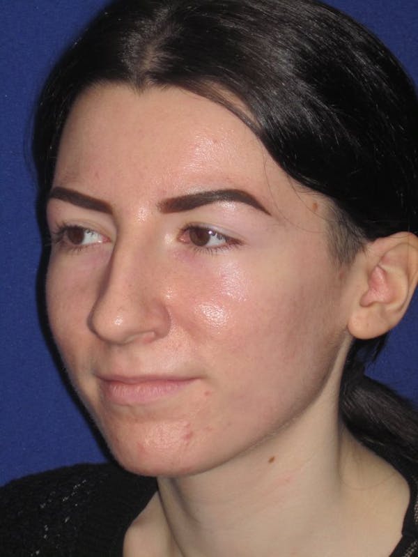 Rhinoplasty Before & After Gallery - Patient 4890973 - Image 3