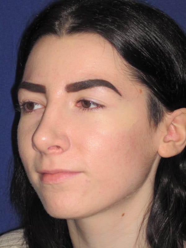 Rhinoplasty Before & After Gallery - Patient 4890973 - Image 4