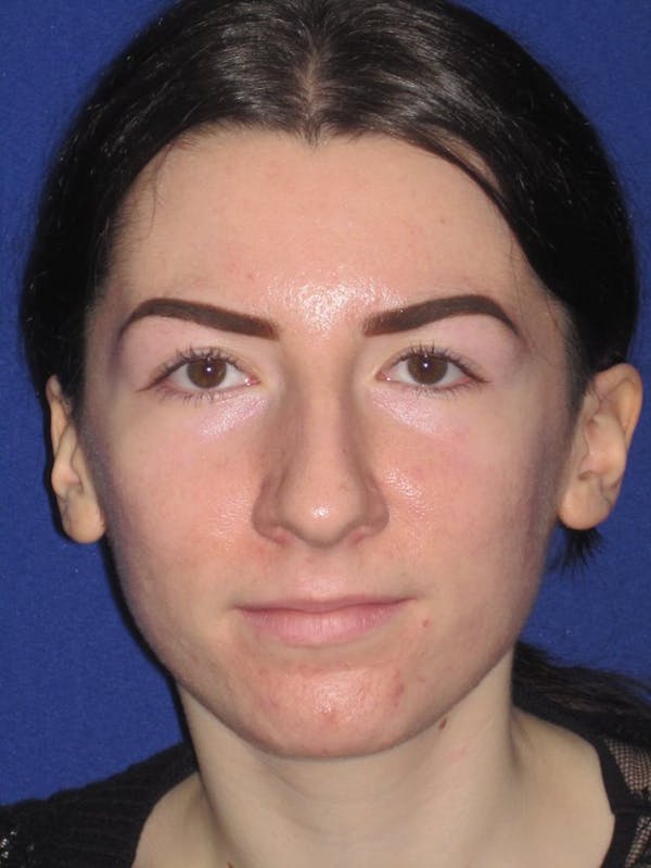 Rhinoplasty Before & After Gallery - Patient 4890973 - Image 5