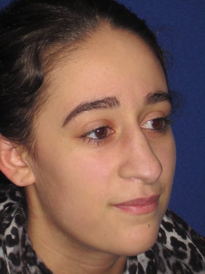 Rhinoplasty Before & After Gallery - Patient 4890977 - Image 1