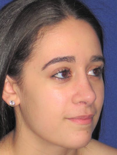 Rhinoplasty Before & After Gallery - Patient 4890977 - Image 2