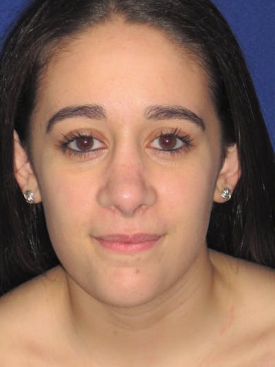 Rhinoplasty Before & After Gallery - Patient 4890977 - Image 4