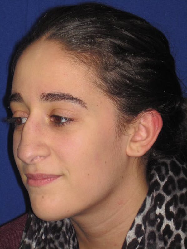Rhinoplasty Before & After Gallery - Patient 4890977 - Image 5