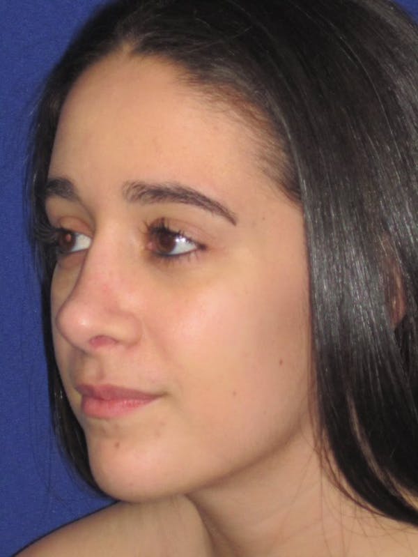 Rhinoplasty Before & After Gallery - Patient 4890977 - Image 6