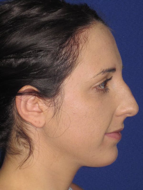 Rhinoplasty Before & After Gallery - Patient 4890983 - Image 1