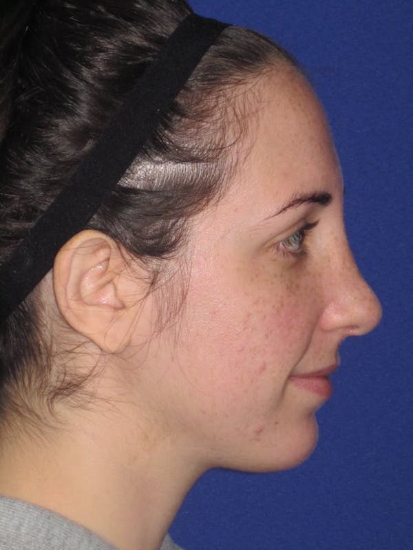 Rhinoplasty Before & After Gallery - Patient 4890983 - Image 2