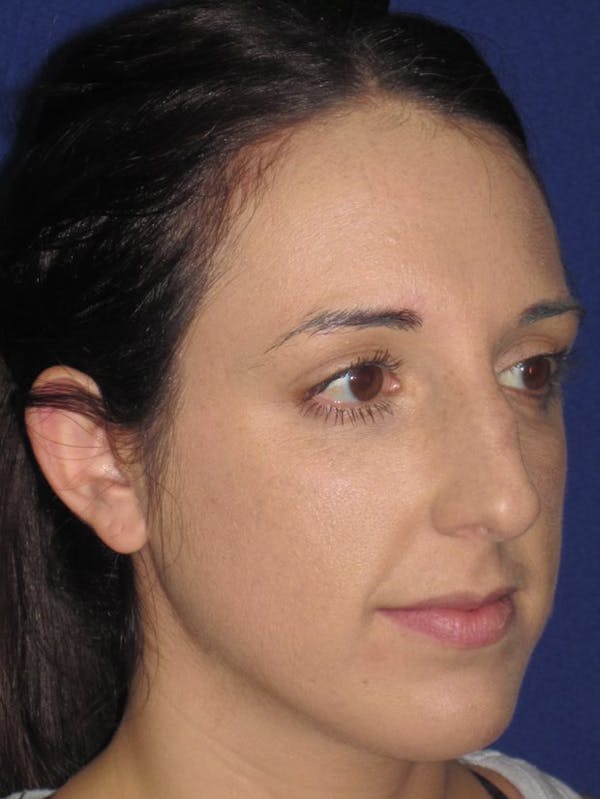 Rhinoplasty Before & After Gallery - Patient 4890983 - Image 3