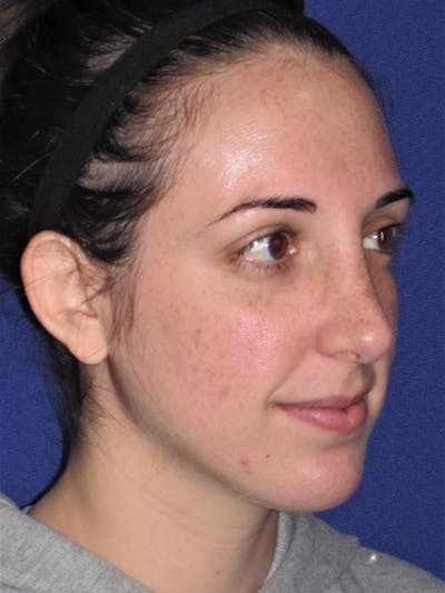 Rhinoplasty Before & After Gallery - Patient 4890983 - Image 4