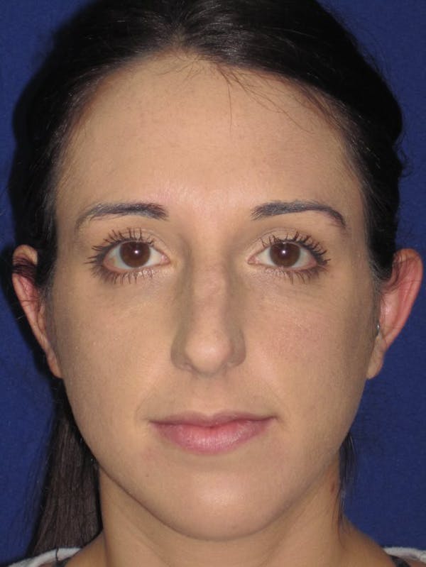 Rhinoplasty Before & After Gallery - Patient 4890983 - Image 5