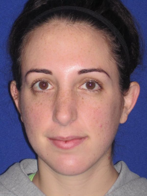 Rhinoplasty Before & After Gallery - Patient 4890983 - Image 6