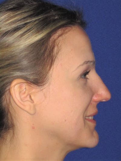 Rhinoplasty Before & After Gallery - Patient 4890987 - Image 1