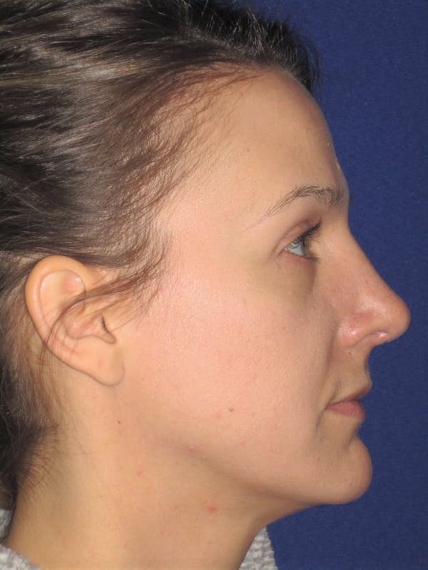 Rhinoplasty Before & After Gallery - Patient 4890987 - Image 2
