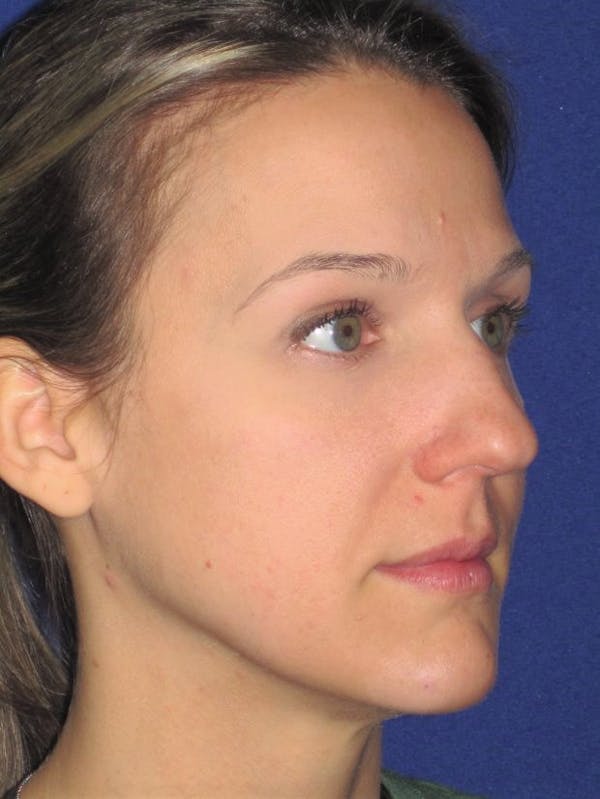 Rhinoplasty Before & After Gallery - Patient 4890987 - Image 3