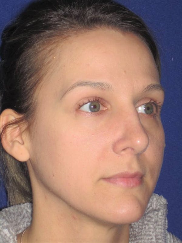 Rhinoplasty Before & After Gallery - Patient 4890987 - Image 4