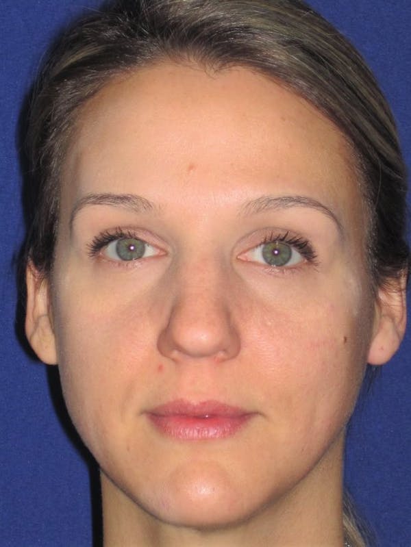 Rhinoplasty Before & After Gallery - Patient 4890987 - Image 5