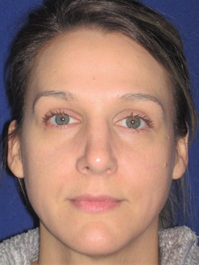 Rhinoplasty Before & After Gallery - Patient 4890987 - Image 6