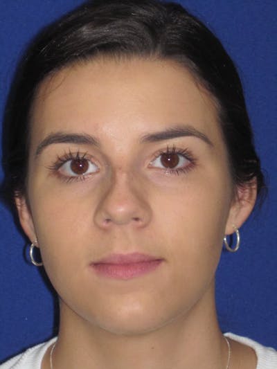 Rhinoplasty Before & After Gallery - Patient 4890995 - Image 1