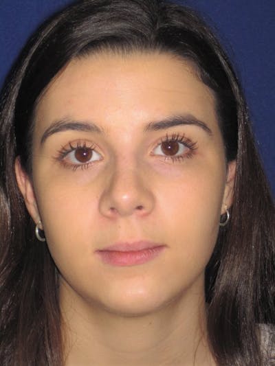 Rhinoplasty Before & After Gallery - Patient 4890995 - Image 2