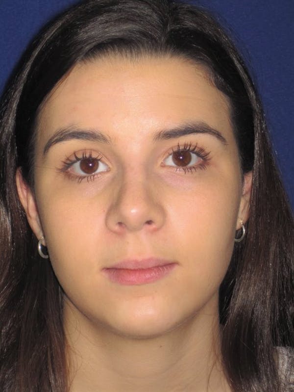 Rhinoplasty Gallery - Patient 4890995 - Image 2