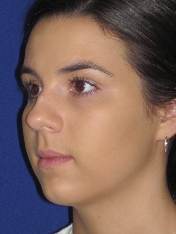 Rhinoplasty Before & After Gallery - Patient 4890995 - Image 3