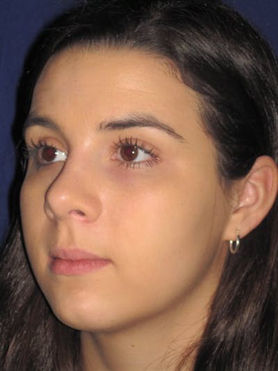 Rhinoplasty Before & After Gallery - Patient 4890995 - Image 4