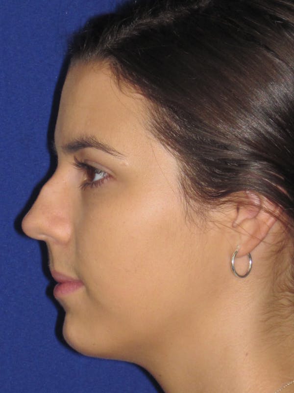 Rhinoplasty Before & After Gallery - Patient 4890995 - Image 5