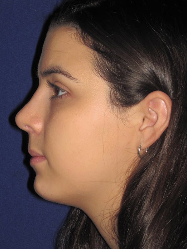 Rhinoplasty Before & After Gallery - Patient 4890995 - Image 6