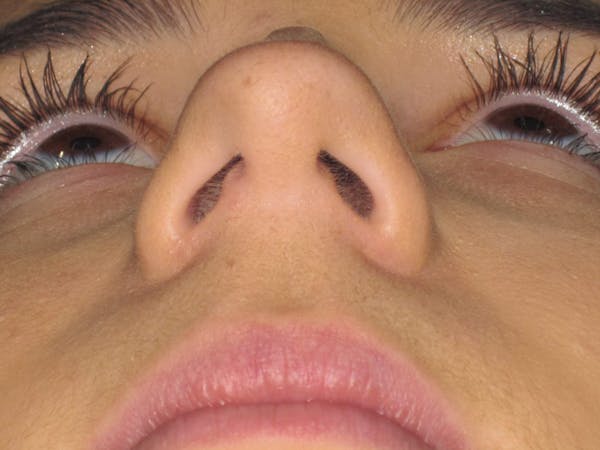 Rhinoplasty Before & After Gallery - Patient 4890995 - Image 7
